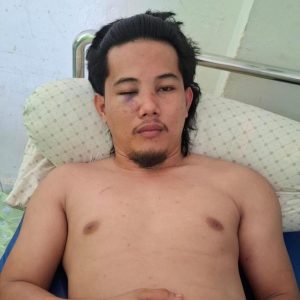 Kader HMI Korban Pengeroyokan Alami Patah Tulang Hidung